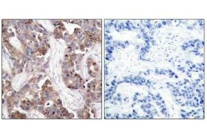 Immunohistochemical analysis of paraffin-embedded human breast carcinoma tissue using Stathmin 1(Phospho-Ser25) Antibody(left) or the same antibody preincubated with blocking peptide(right). (Stathmin 1 Antikörper  (pSer25))