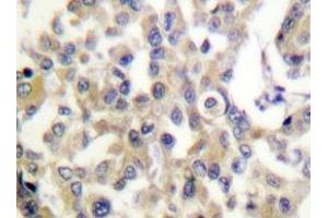 Immunohistochemistry analyzes of Vimentin antibody in paraffin-embedded human breast carcinoma tissue. (Vimentin Antikörper)