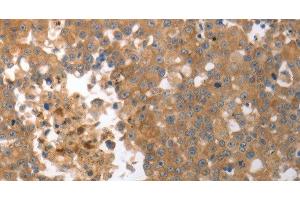 Immunohistochemistry of paraffin-embedded Human breast cancer tissue using MMP27 Polyclonal Antibody at dilution 1:50