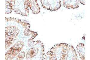 Formalin-fixed, paraffin-embedded human Colon Carcinoma stained with Villin Mouse Monoclonal Antibody (VIL1/1314 + VIL1/2376). (Villin 1 Antikörper  (AA 179-311))