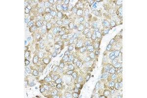 Immunohistochemistry of paraffin-embedded human liver cancer using HSP90B1 Rabbit pAb (ABIN6130434, ABIN6142031, ABIN6142033 and ABIN7101795) at dilution of 1:50 (40x lens). (GRP94 Antikörper  (AA 550-650))