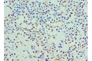 Immunohistochemistry of paraffin-embedded human breast cancer using ABIN7142608 at dilution of 1:100 (Coq7 Antikörper  (AA 37-217))