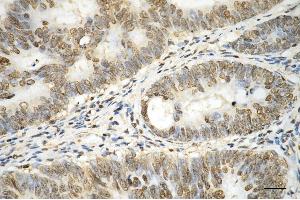 Immunohistochemistry was performed on paraffin-embedded human sigmoid colon carcinoma using histone H3 (mono methyl K14) antibody (ABIN7798958), 1:200). (Rekombinanter Histone 3 Antikörper  (H3K14me1))