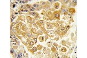 IHC analysis of FFPE human lung carcinoma tissue stained with TLR2 antibody (TLR2 Antikörper  (AA 212-242))