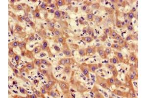 Immunohistochemistry of paraffin-embedded human liver cancer using ABIN7169266 at dilution of 1:100 (PPP2CA Antikörper  (Catalytic Subunit alpha))