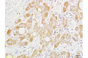 Formalin-fixed and paraffin embedded human liver carcinoma labeled with Anti-Phospho-PRAS40 (Thr246) Polyclonal Antibody, Unconjugated (ABIN744953) at 1:200 followed by conjugation to the secondary antibody and DAB staining