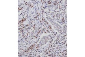Immunohistochemical analysis of A on paraffin-embedded Human breast carcinoma tissue. (CDC25A Antikörper  (pSer124))