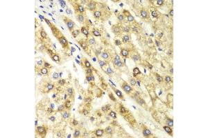 Immunohistochemistry of paraffin-embedded human liver cancer using CTBP1 antibody (ABIN5970855) at dilution of 1/100 (40x lens). (CTBP1 Antikörper)
