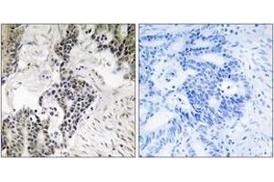 Immunohistochemistry analysis of paraffin-embedded human colon carcinoma, using CDC25C (Phospho-Ser198) Antibody.