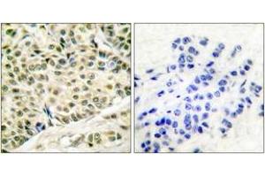 Immunohistochemistry analysis of paraffin-embedded human breast carcinoma tissue, using MCM2 Antibody. (MCM2 Antikörper  (AA 1-50))