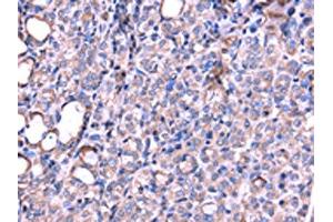The image on the left is immunohistochemistry of paraffin-embedded Human thyroid cancer tissue using ABIN7131190(SRPK3 Antibody) at dilution 1/20, on the right is treated with fusion protein. (SRPK3 Antikörper)