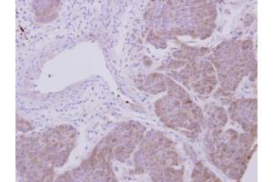 IHC-P Image Immunohistochemical analysis of paraffin-embedded human breast cancer, using Peroxiredoxin 2, antibody at 1:500 dilution. (Peroxiredoxin 2 Antikörper)