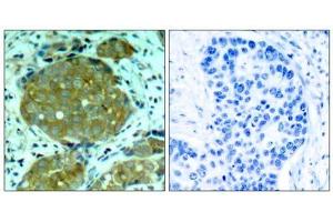 Immunohistochemical analysis of paraffin-embedded human breast carcinoma tissue, using NFκB-p105/p50 (phospho-Ser932) antibody (E011251). (NFKB1 Antikörper  (pSer932))