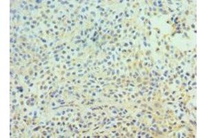 Immunohistochemistry of paraffin-embedded human breast cancer using ABIN7147301 at dilution of 1:100 (CDC16 Antikörper  (AA 371-620))