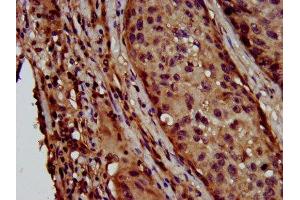 IHC image of ABIN7158792 diluted at 1:600 and staining in paraffin-embedded human lung cancer performed on a Leica BondTM system. (LAPTM4B Antikörper  (AA 174-226))