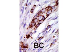 Formalin-fixed and paraffin-embedded human cancer tissue reacted with GRK5 polyclonal antibody  , which was peroxidase-conjugated to the secondary antibody, followed by DAB staining . (GRK5 Antikörper  (C-Term))