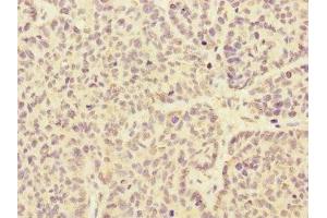 Immunohistochemistry of paraffin-embedded human ovarian cancer using ABIN7167981 at dilution of 1:100 (ARHGEF3 Antikörper  (AA 287-526))