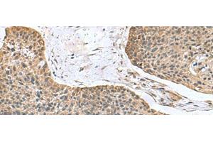 Immunohistochemistry of paraffin-embedded Human esophagus cancer tissue using NFS1 Polyclonal Antibody at dilution of 1:100(x200) (NFS1 Antikörper)