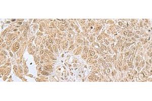 Immunohistochemistry of paraffin-embedded Human lung cancer tissue using PHF6 Polyclonal Antibody at dilution of 1:85(x200) (PHF6 Antikörper)