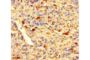 Immunohistochemistry of paraffin-embedded human melanoma using ABIN7176271 at dilution of 1:100 (ZNF384 Antikörper  (AA 1-245))