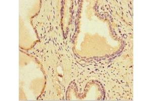 Immunohistochemistry of paraffin-embedded human prostate cancer using ABIN7164517 at dilution of 1:100 (SMARCA1 Antikörper  (AA 500-601))