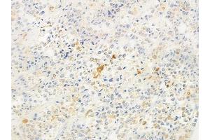 ABIN6260823 and ABIN6278219 at 1/100 staining human prostate carcinoma by IHC-P.