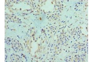 Immunohistochemistry of paraffin-embedded human breast cancer using ABIN7166400 at dilution of 1:100
