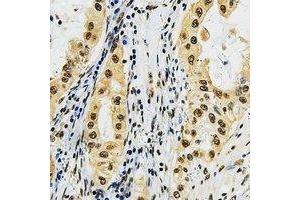 Immunohistochemical analysis of LMO3 staining in human lung cancer formalin fixed paraffin embedded tissue section. (LMO3 Antikörper  (C-Term))
