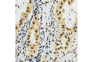 Immunohistochemical analysis of LMO3 staining in human lung cancer formalin fixed paraffin embedded tissue section.