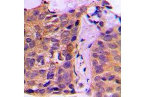 Immunohistochemical analysis of 14-3-3 zeta staining in human breast cancer formalin fixed paraffin embedded tissue section. (14-3-3 zeta Antikörper  (Center))