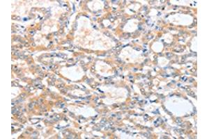 The image on the left is immunohistochemistry of paraffin-embedded Human thyroid cancer tissue using ABIN7128218(ACY3 Antibody) at dilution 1/25, on the right is treated with fusion protein. (Aminoacylase 3 Antikörper)
