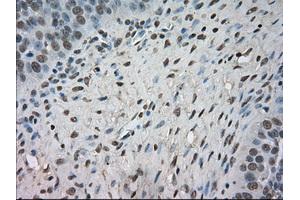 Immunohistochemical staining of paraffin-embedded Adenocarcinoma of colon tissue using anti-NTRK3mouse monoclonal antibody.