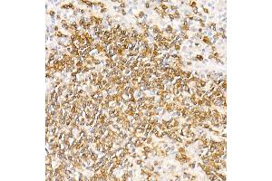 Immunohistochemistry of paraffin-embedded Human nodular Hodgkin lymphoma using CD79a antibody (ABIN7265805) at dilution of 1:100 (40x lens). (CD79a Antikörper)