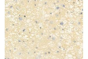 ABIN6257174 and ABIN6275113 at 1/100 staining human astrocytoma by IHC-P. (Epsin 2 Antikörper  (Internal Region))