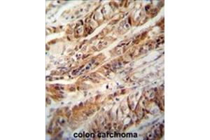 ZC3H15 antibody (C-term) immunohistochemistry analysis in formalin fixed and paraffin embedded human colon carcinoma followed by peroxidase conjugation of the secondary antibody and DAB staining.