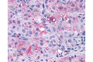 Anti-GRM4 / MGLUR4 antibody IHC of human Skin, Melanoma.