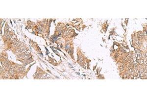 Immunohistochemistry of paraffin-embedded Human colorectal cancer tissue using HLA-E Polyclonal Antibody at dilution of 1:50(x200) (HLA-E Antikörper)