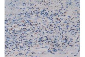 IHC-P analysis of Human Prostate Gland Cancer Tissue, with DAB staining. (IGFBP4 Antikörper  (AA 22-258))