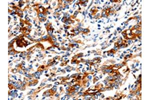 The image on the left is immunohistochemistry of paraffin-embedded Human gastric cancer tissue using ABIN7130018(KLK15 Antibody) at dilution 1/15, on the right is treated with fusion protein. (Kallikrein 15 Antikörper)