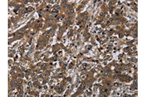 The image on the left is immunohistochemistry of paraffin-embedded Human liver cancer tissue using ABIN7191253(LAIR2 Antibody) at dilution 1/20, on the right is treated with synthetic peptide. (LAIR2 Antikörper)
