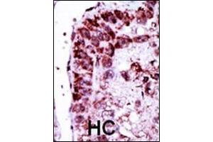 Formalin-fixed and paraffin-embedded human cancer tissue reacted with the primary antibody, which was peroxidase-conjugated to the secondary antibody, followed by DAB staining. (Adenylate Kinase 2 Antikörper  (N-Term))