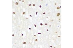 Immunohistochemical analysis of p62 staining in human esophageal cancer formalin fixed paraffin embedded tissue section. (KHDRBS1 Antikörper)