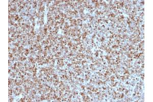 Formalin-fixed, paraffin-embedded human Follicular Lymphoma stained with BCL-6 Mouse Monoclonal Antibody (BCL6/1527).
