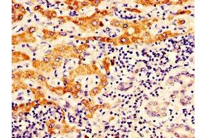 IHC image of ABIN7162288 diluted at 1:400 and staining in paraffin-embedded human liver cancer performed on a Leica BondTM system. (OTC Antikörper  (AA 33-354))