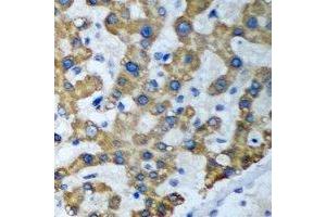 Immunohistochemical analysis of ACT1 staining in human liver cancer formalin fixed paraffin embedded tissue section. (TRAF3IP2 Antikörper)