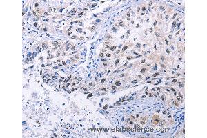 Immunohistochemistry of Human lung cancer using HMGB3 Polyclonal Antibody at dilution of 1:20