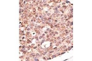 Formalin-fixed and paraffin-embedded human cancer tissue reacted with the primary antibody, which was peroxidase-conjugated to the secondary antibody, followed by DAB staining. (CRY2 Antikörper  (C-Term))