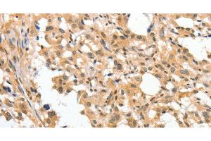 Immunohistochemistry of paraffin-embedded Human thyroid cancer tissue using APTX Polyclonal Antibody at dilution 1:50 (Aprataxin Antikörper)