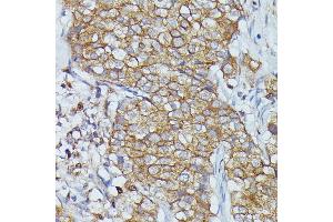 Immunohistochemistry of paraffin-embedded human mammary cancer using Cortactin antibody  at dilution of 1:100 (40x lens). (Cortactin Antikörper  (AA 1-200))