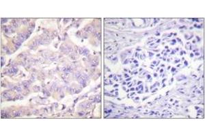 Immunohistochemistry analysis of paraffin-embedded human colon carcinoma tissue, using c-PLA2 (Ab-505) Antibody. (C-PLA2 (AA 471-520) Antikörper)
